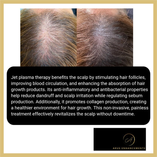 Root Cold Plasma Scalp + HB